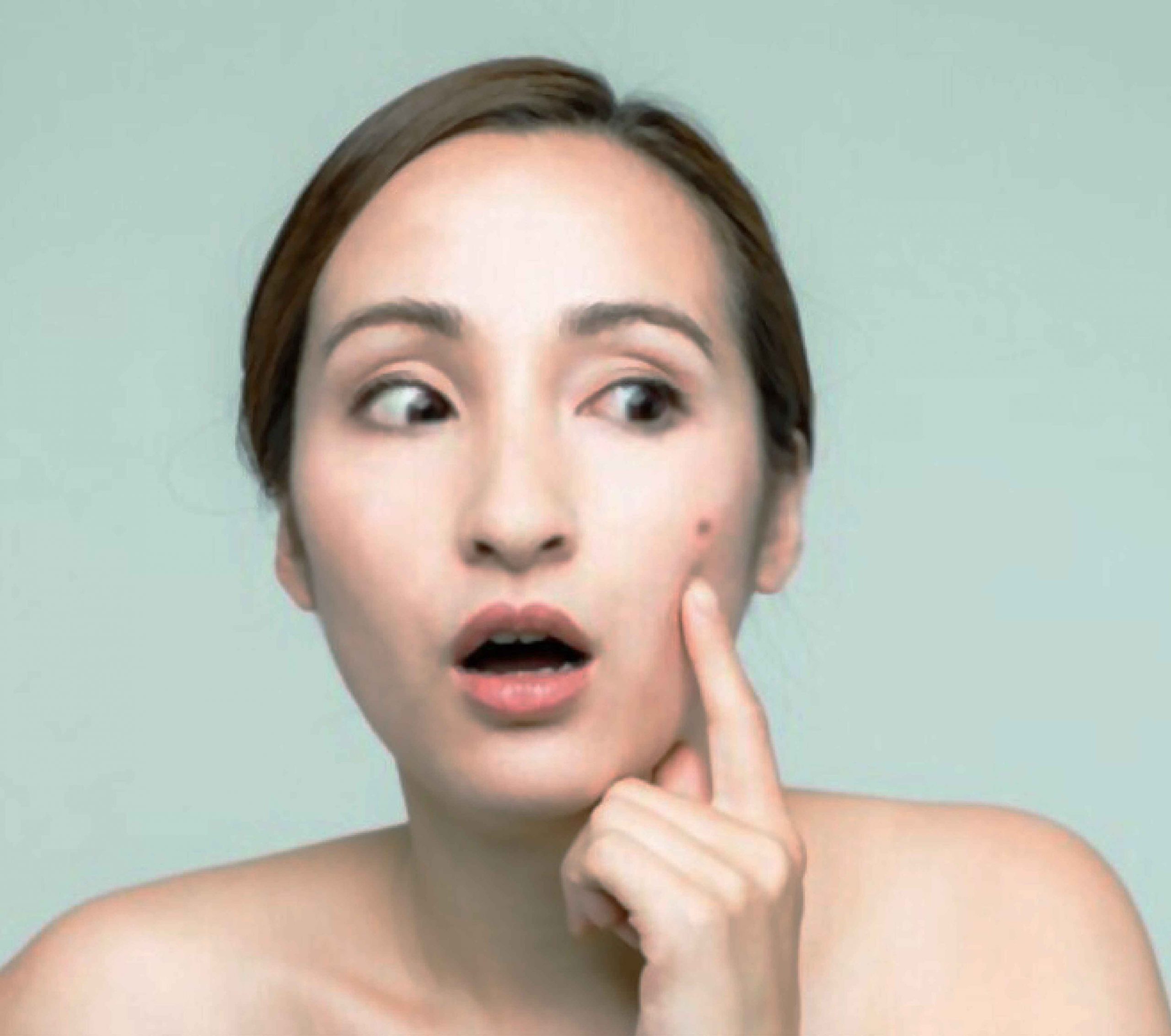 acne series